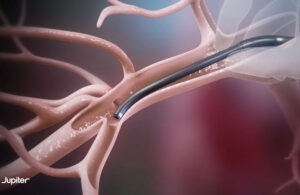 Neptune Medical spinout Jupiter Endovascular is working to develop the endoportal procedure, a new class of endovascular procedures using Endoportal Control.